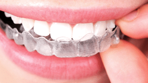 Un)Traditional Braces, Colored Metal Braces in Milwaukee WI, Beloit WI,  and Roscoe IL