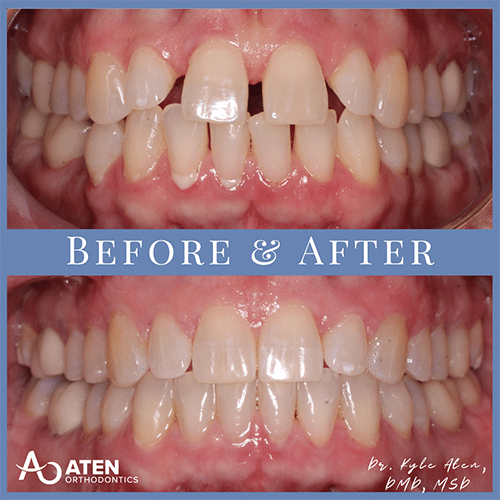 Before and After Aten Orthodontics Invisalign and Braces For All Ages